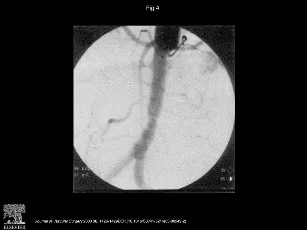 Fig 4 Completion angiogram shows the 2 AneuRx grafts in place, exclusion of the aneurysm, and no sign of endoleak.