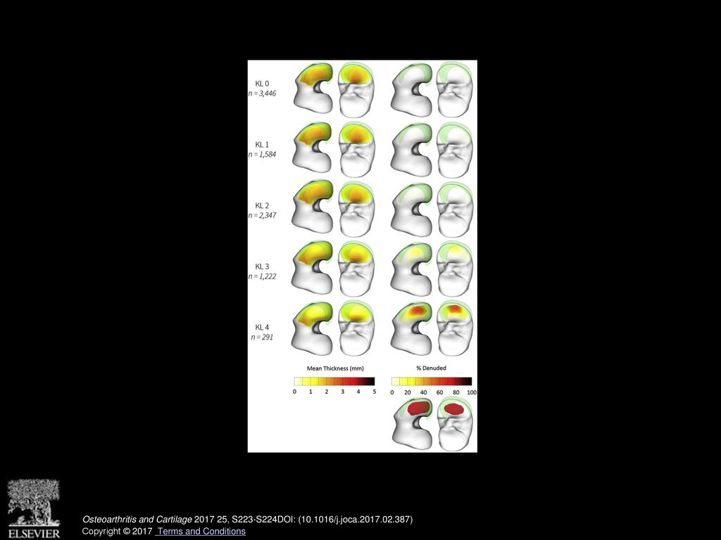 Figure 1: Mean thickness and denudation of medial femorotibial cartilage thickness by KL. grade. All thickness and denudation measures are displayed on the mean bone shape. The mean position and size of the medial meniscus is shown as a transparent green structure to provide orientation to the view. The pale yellow peripheral rim on the denudation maps should be disregarded – this is caused by slight differences in the boundaries of measurement across the population sample. Regions used in this study are shown at the bottom right.