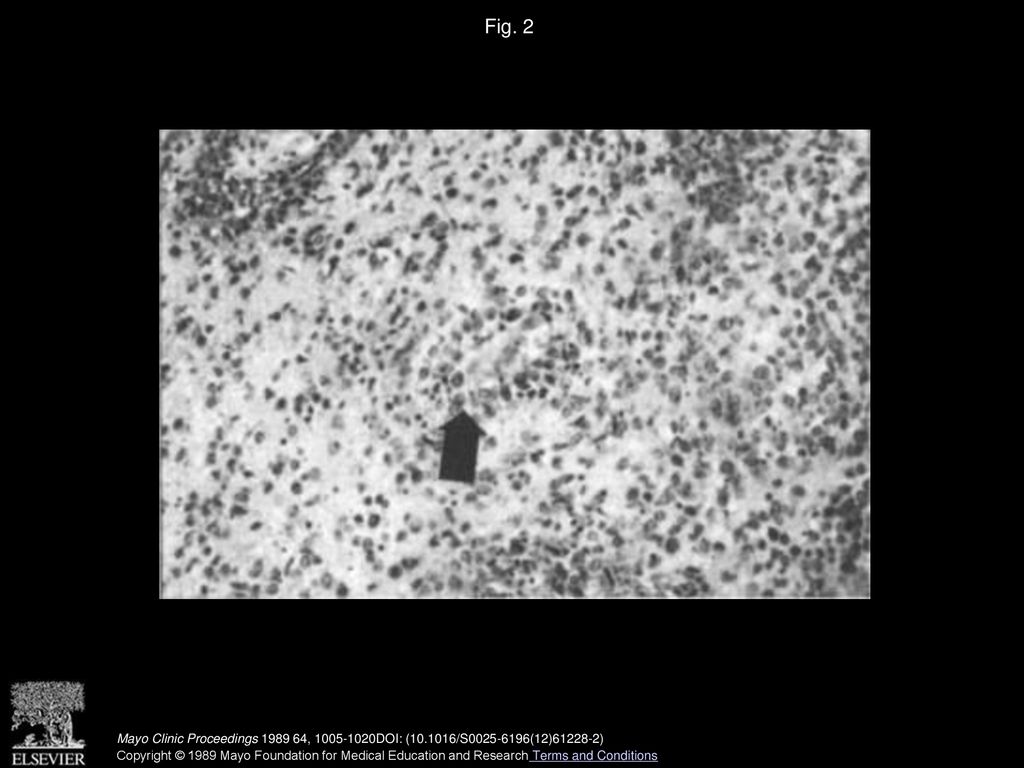 Fig. 2 Perivascular accumulation (arrow) of neoplastic lymphocytes and infiltration of surrounding brain. (Hematoxylin-eosin; ×100.)