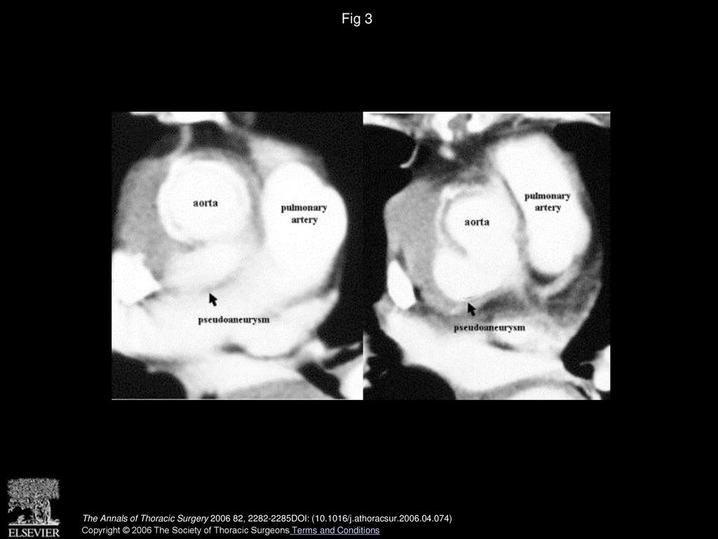 Fig 3 Computed tomography showing the pseudoaneurysm of the aortic root (right, the lower part; left, the upper).