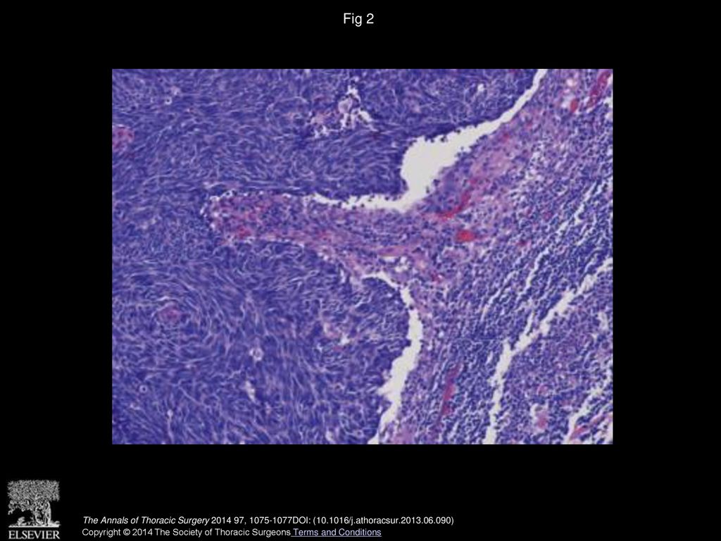 Fig 2 Metastasis of squamous cell carcinoma in paraesophageal lymph node. (Hematoxylin and eosin, ×100.)