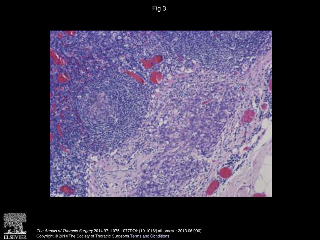 Fig 3 Metastasis of small cell carcinoma in paracardiac lymph node. (Hematoxylin and eosin, ×100.)