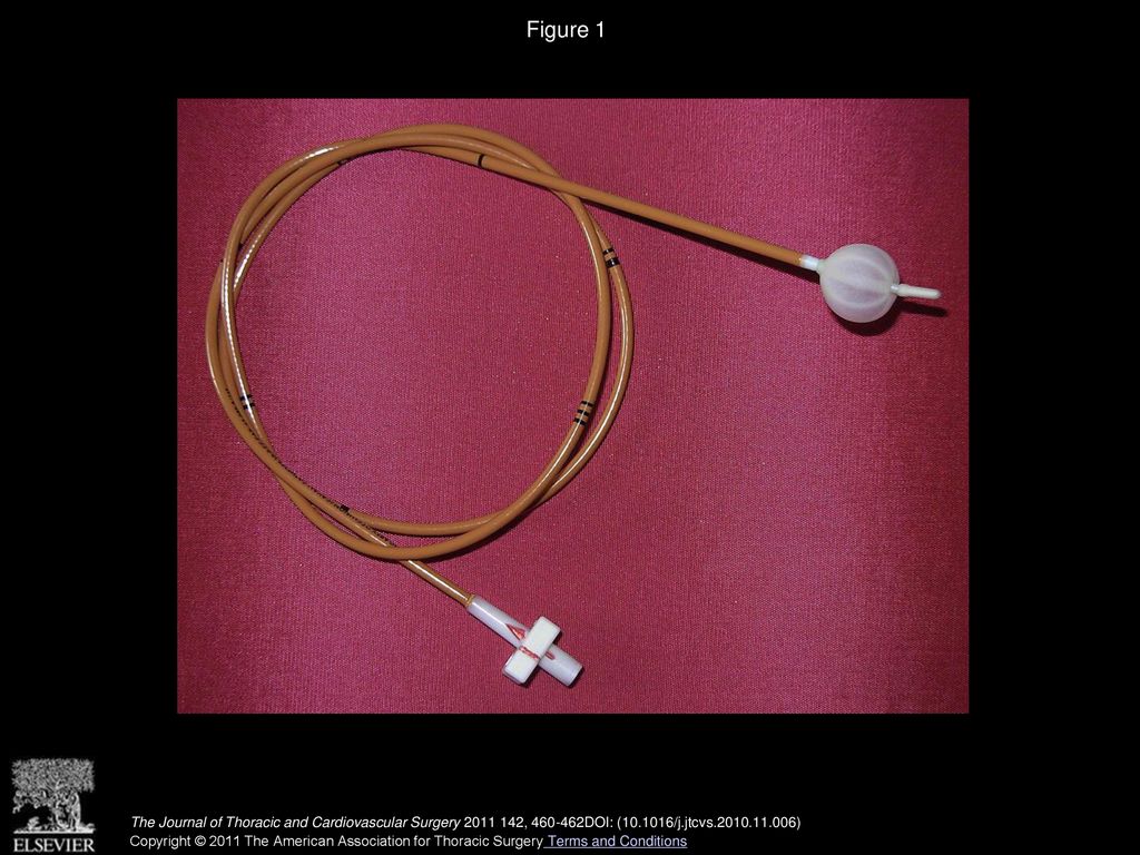 Figure 1 A Fogarty 8F occlusion catheter with a 14F balloon.
