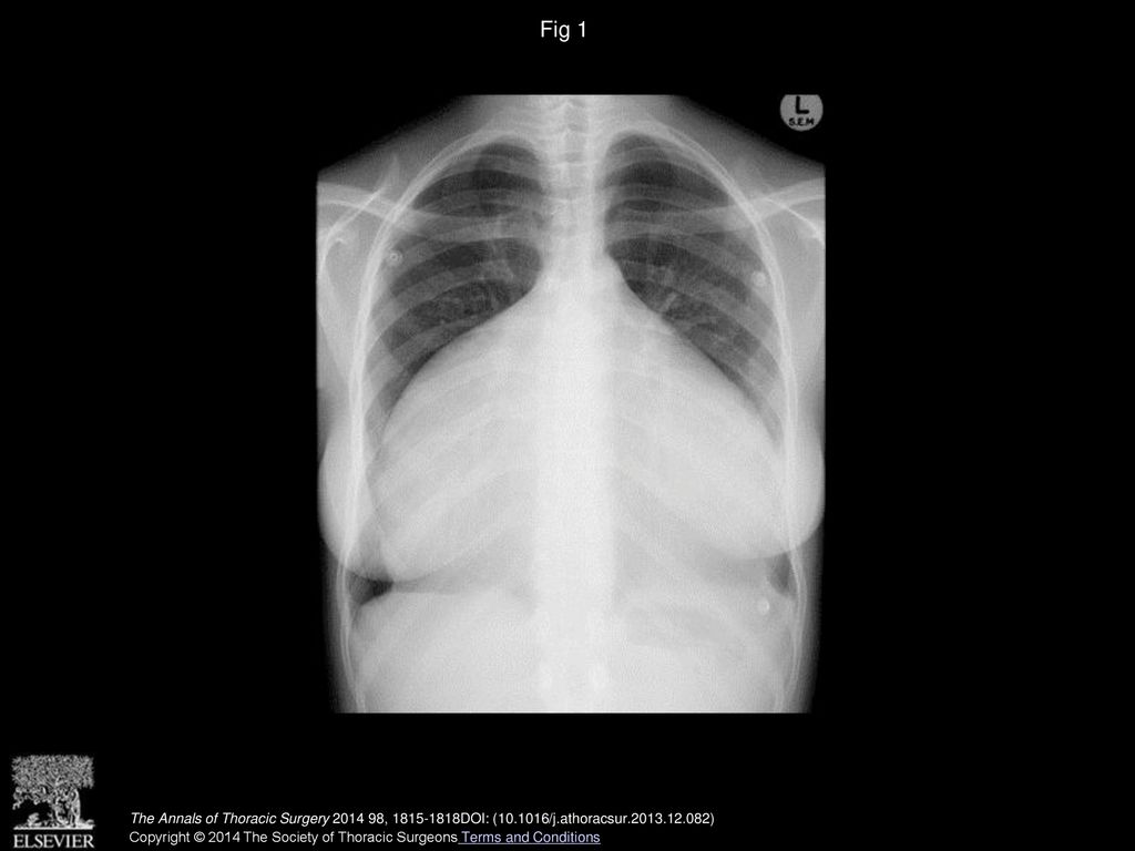 Fig 1 Chest radiograph demonstrating severe cardiomegaly.