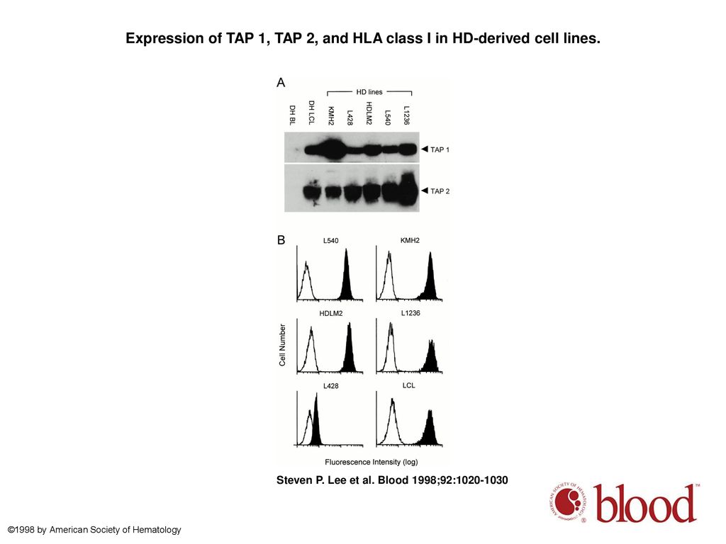 Expression of TAP 1, TAP 2, and HLA class I in HD-derived cell lines.