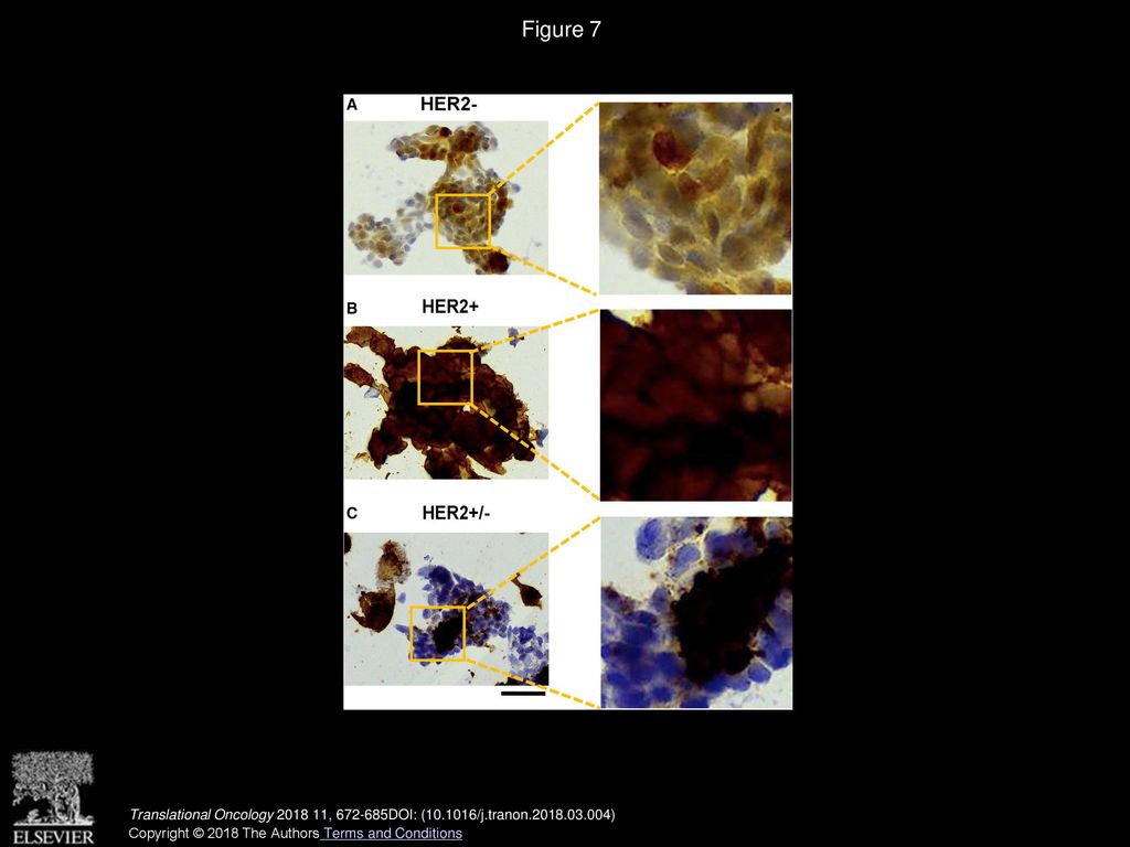Figure 7 Immunohistochemistry of breast cancer multicellular tumor spheroids with different HER2 expression.