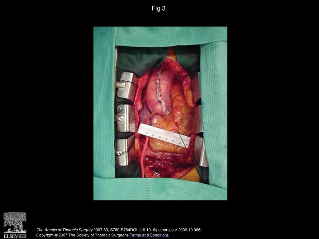 Fig 3 Final operative view demonstrates aortic diameter reduction of a dilated aneurysmal ascending aorta with fine Dacron mesh wrap.