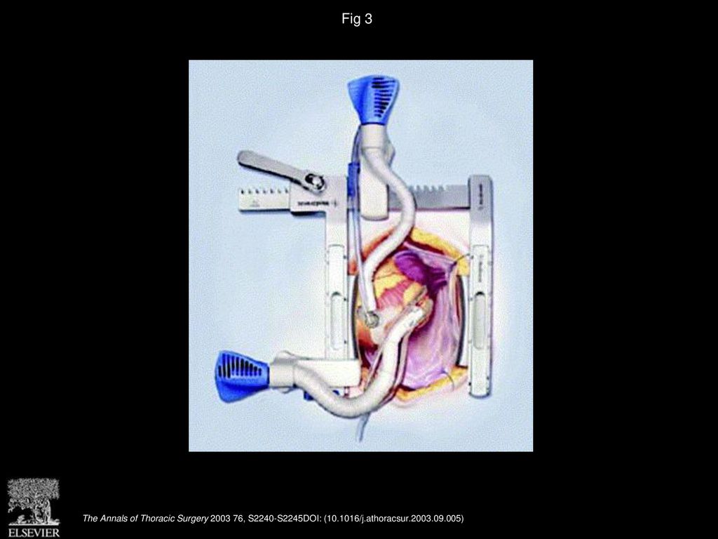 Fig 3 Suction exposure and suction stabilization for off-pump coronary artery bypass graft surgery.