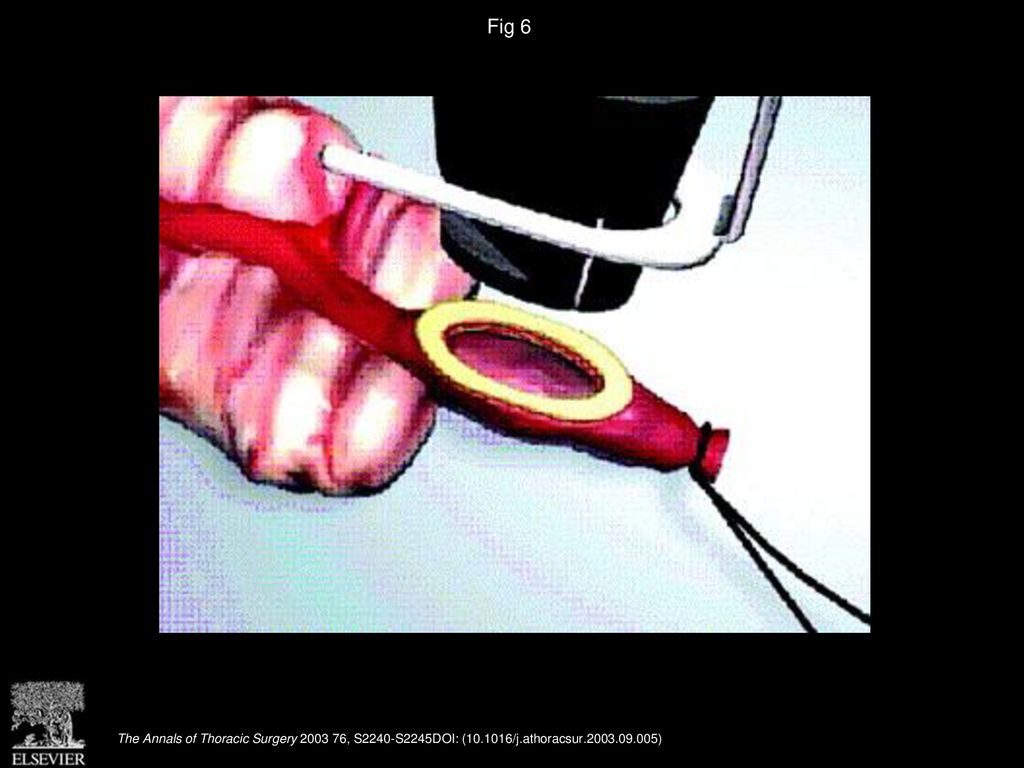 Fig 6 Magnetic anastomotic device.