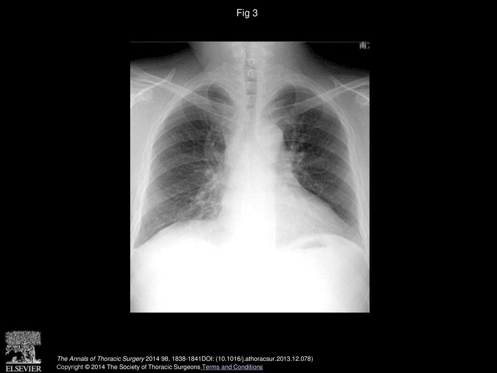 Fig 3 Chest radiograph showed dramatic improvement after corticosteroid therapy.