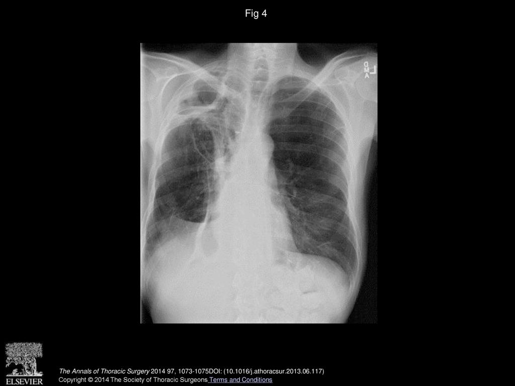Fig 4 Chest X-ray at 6 months follow-up.