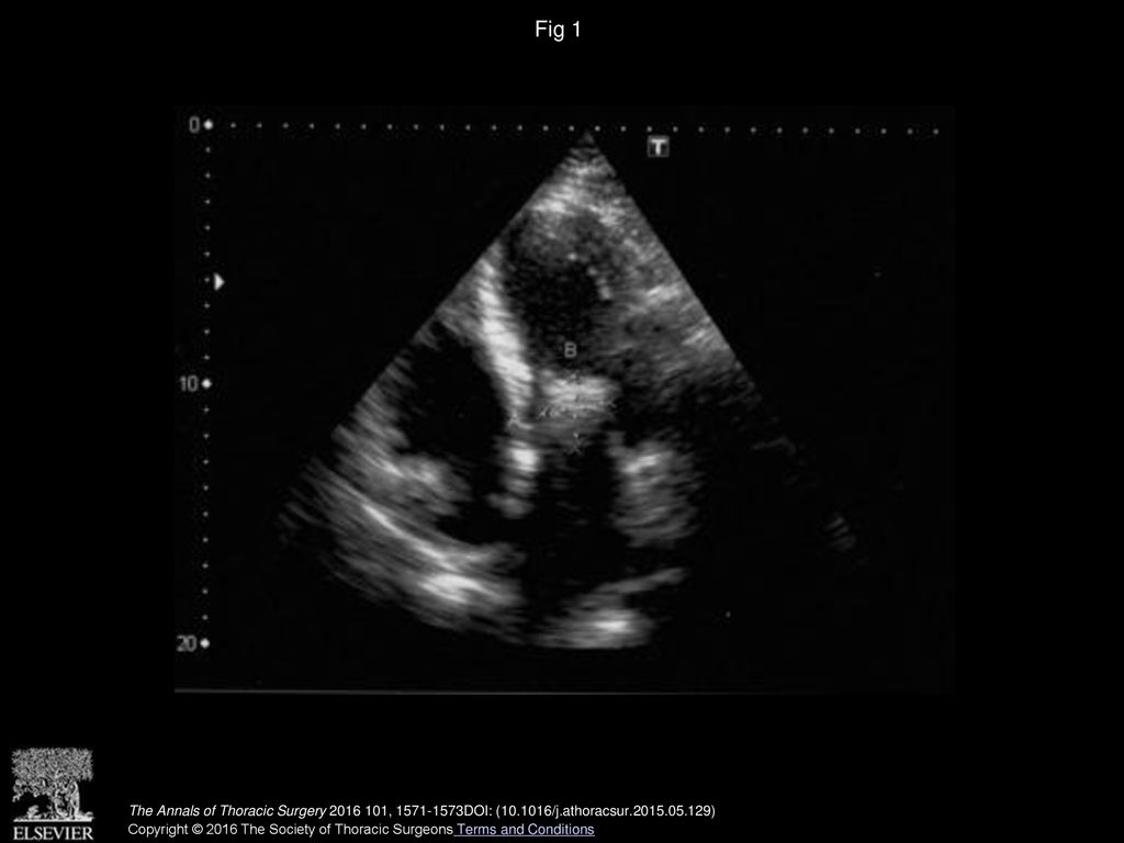 Fig 1 Transthoracic echocardiogram showing a myxomatous mass in the left atrium in close proximity to the mitral valve and measuring 2.6 × 2.7 cm.