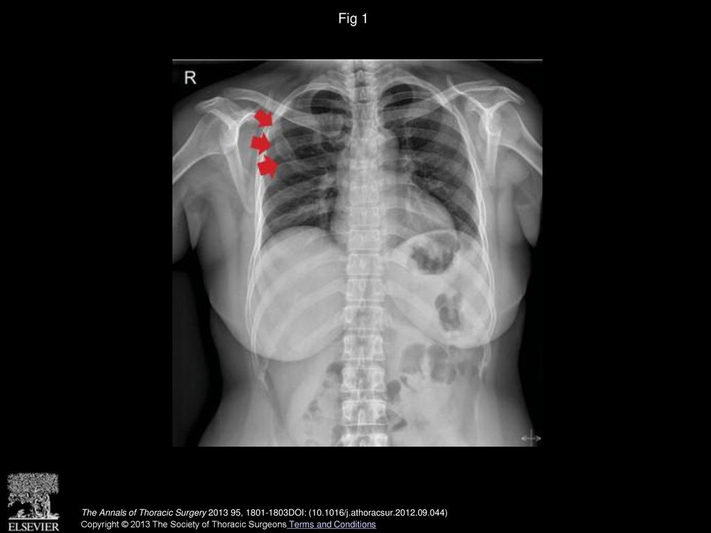 Fig 1 Chest roentgenogram showing an expansile and osteolytic lesion (red arrows) in the right second rib.
