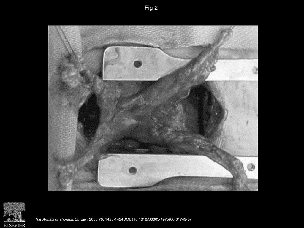 Fig 2 An en bloc resection of the thymus and mediastinal fat performed through the mini-sternotomy.