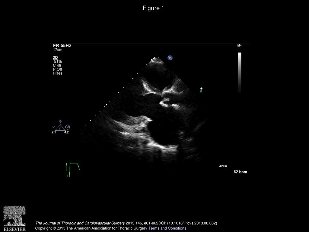 Figure 1 Parasternal, 2-dimensional, long-axis view showing absent mitral valve and thickened aortic valve cusps after repair.