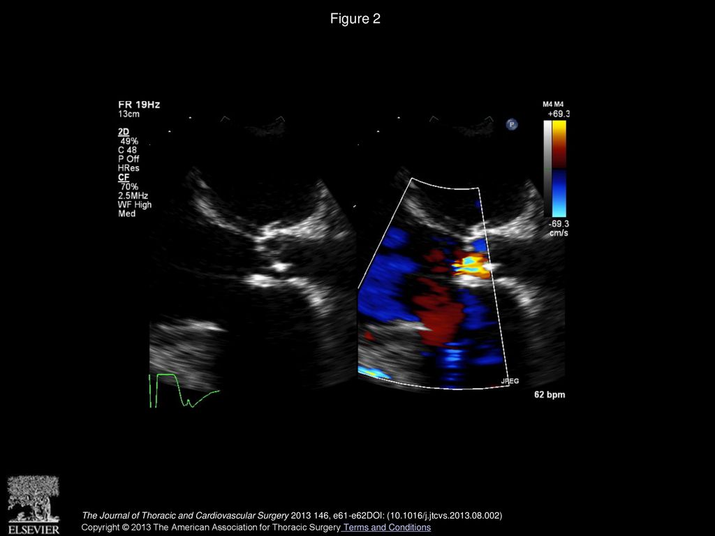 Figure 2 Parasternal, color Doppler, long-axis view showing free mitral regurgitation and trivial aortic insufficiency.