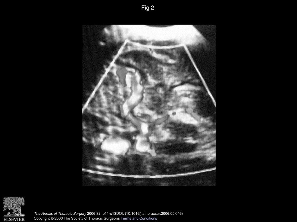 Fig 2 Aortic arch ultrasound shows the ascending aorta bifurcating into two common carotid arteries.