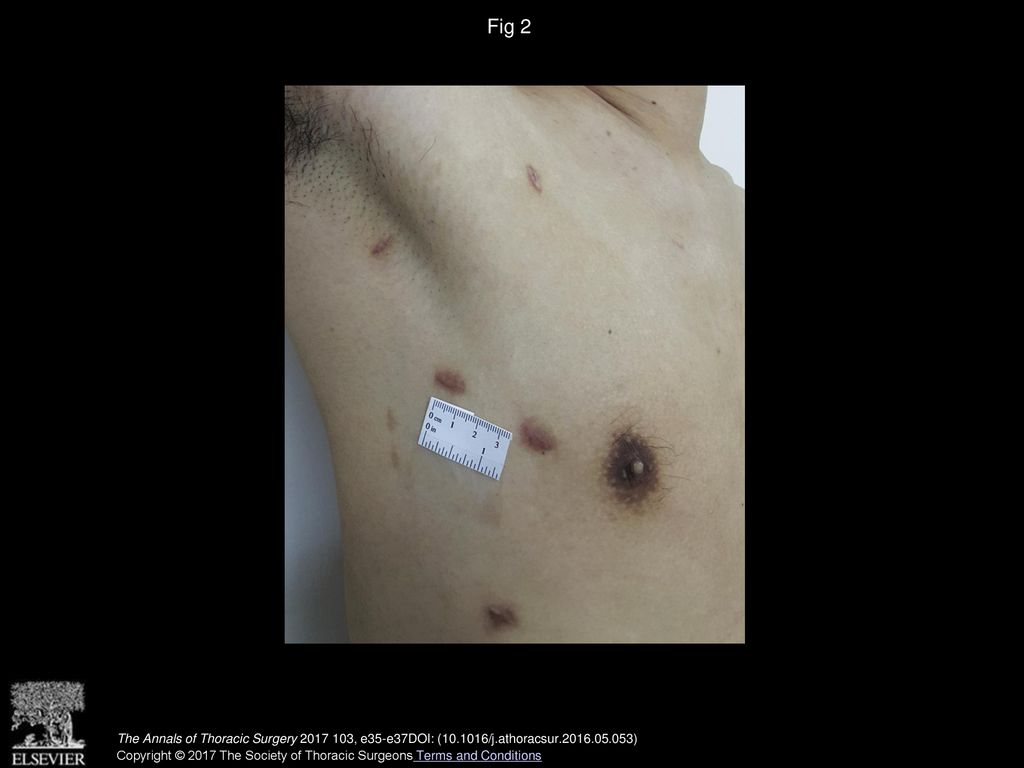 Fig 2 Maximal surgical wound only 12 mm.