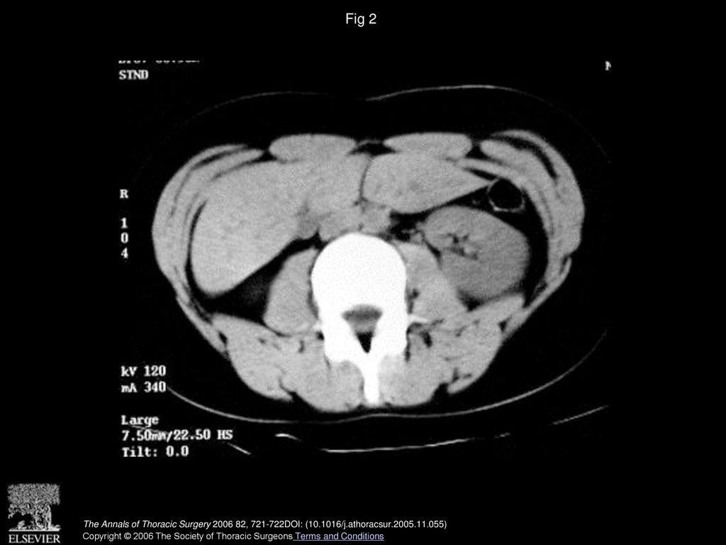Fig 2 Abdominal computed tomographic scan showing absence of viscera.