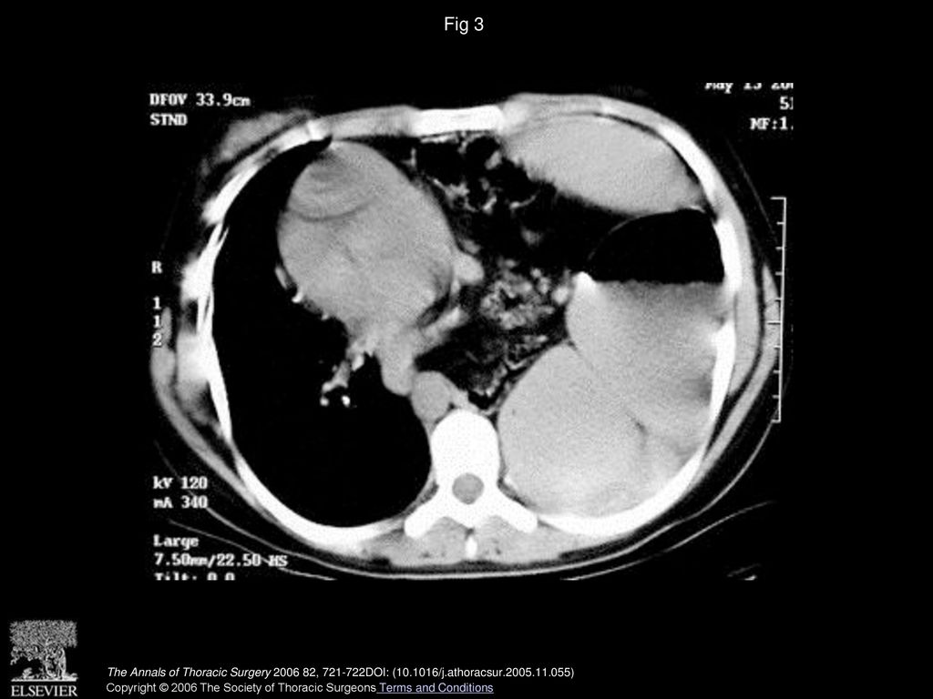 Fig 3 Chest computed tomographic scan showing stomach, intestines, and spleen in the left pleural cavity.