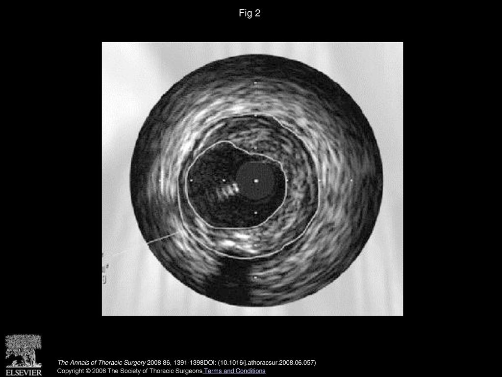 Fig 2 Intravascular ultrasound used to calculate area and percentage of stenosis flow by dividing the lumen diameter by vessel diameter.