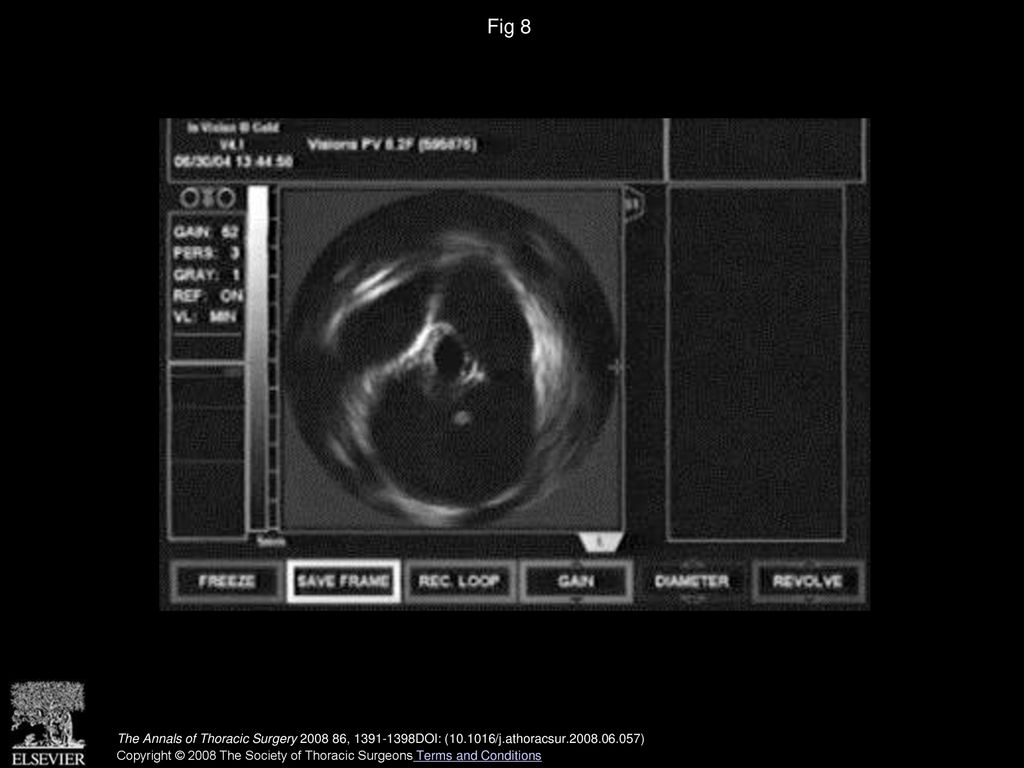 Fig 8 Intravascular ultrasound demonstrates a type B dissection with a dissecting flap separating a compressed true lumen.