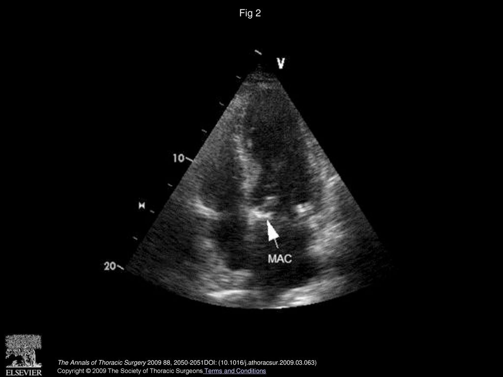 Fig 2 Mitral annular calcification (MAC) causing failure of vent insertion (arrow).