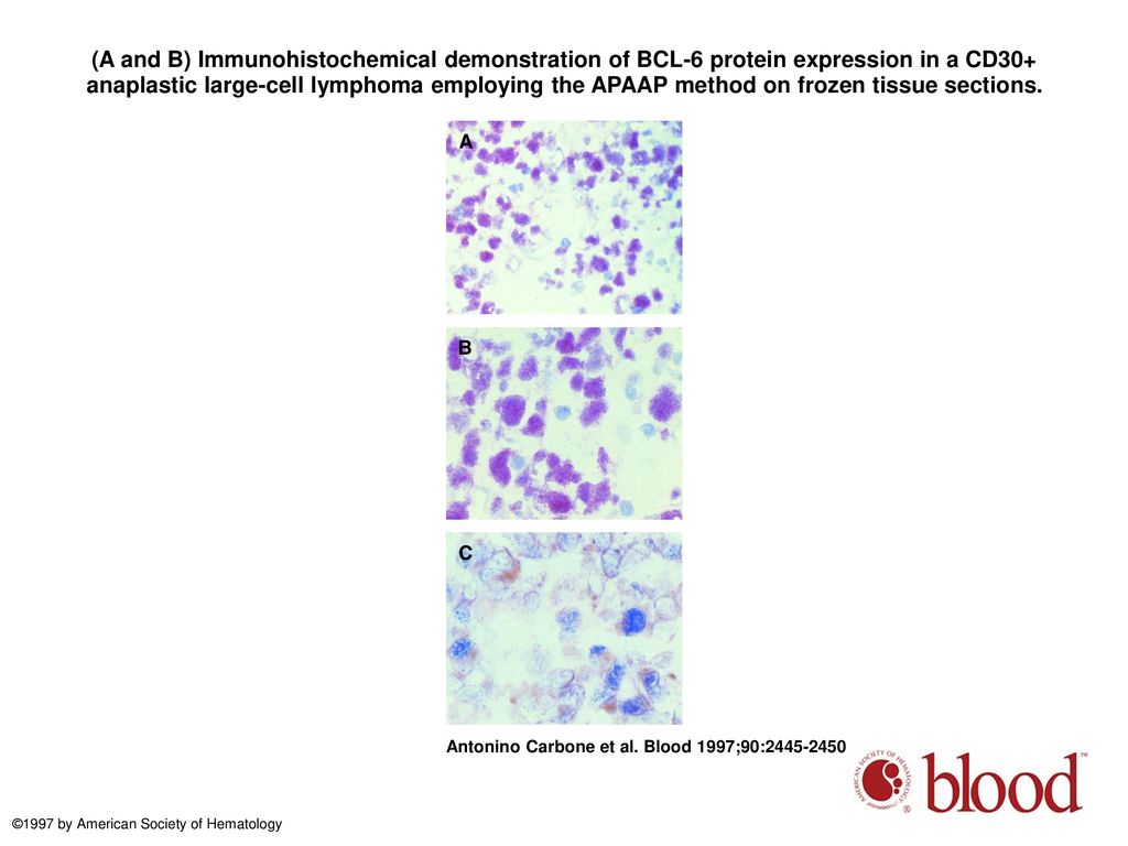(A and B) Immunohistochemical demonstration of BCL-6 protein expression in a CD30+ anaplastic large-cell lymphoma employing the APAAP method on frozen tissue sections.
