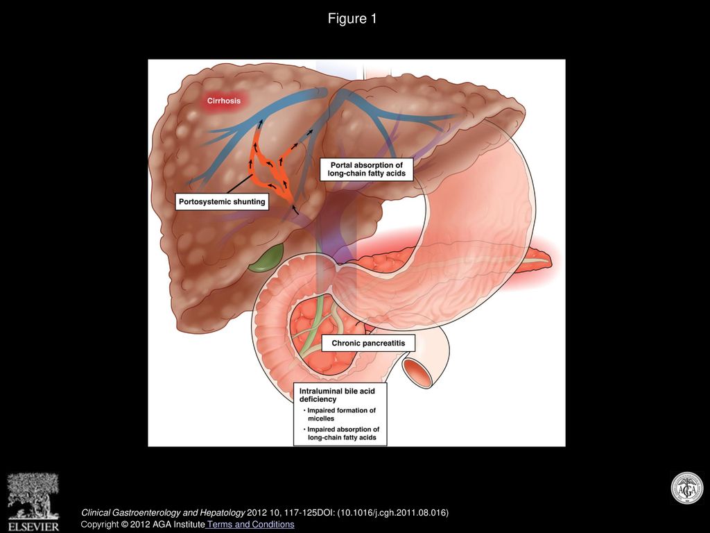 Figure 1 Possible factors contributing to lipid maldigestion or malabsorption in patients with cirrhosis or chronic pancreatitis.