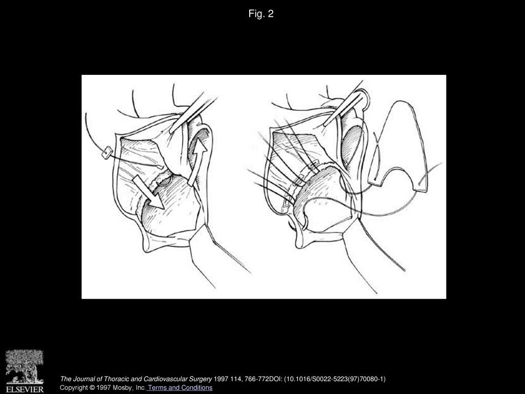 Fig. 2 A properly tailored patch is used to reconstruct the intervalvular fibrous body.