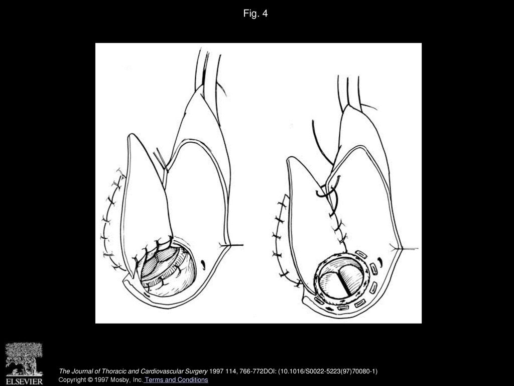 Fig. 4 An aortic valve prosthesis is secured to the aortic anulus and patch. The patch is used to close the right side of the aortotomy.