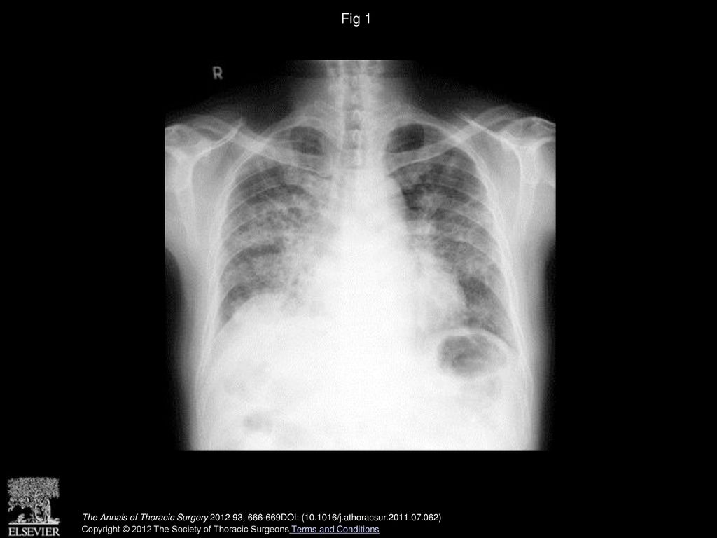 Fig 1 Chest radiograph on admission showed bilateral, patchy infiltrates.