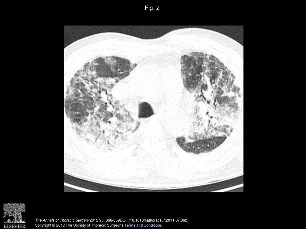 Fig. 2 High-resolution computed tomography scan of the chest showed bilateral areas of air-space consolidation and ground-glass opacity.