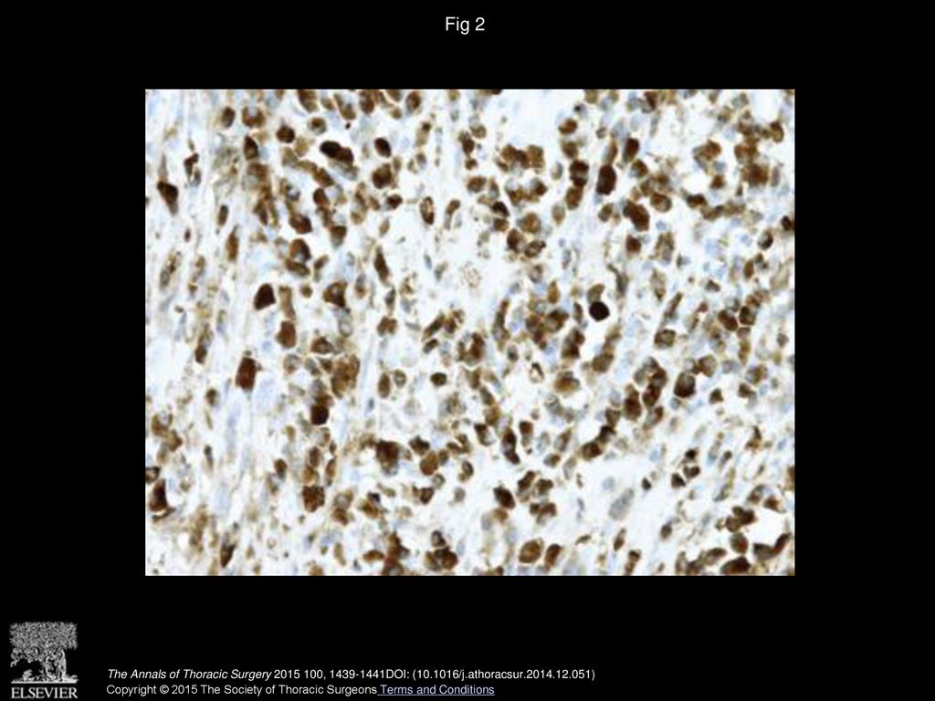 Fig 2 Immunostaining for immunoglobulin-positive cells showing numerous IgG-positive plasma cells (original magnification ×400).
