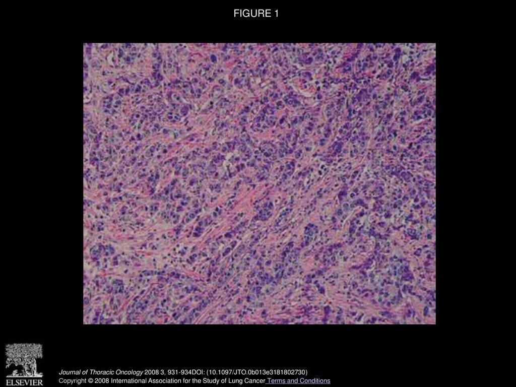 FIGURE 1 Microscopic findings of the right breast tumor reveal a ductal cancer cell type, and growth in well-defined nests (H&E stain, ×200).
