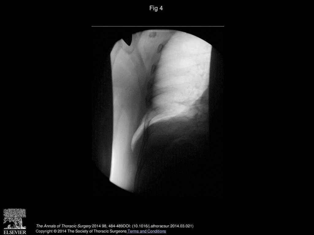 Fig 4 Fluoroscopic demonstration of an acquired chest wall hernia.