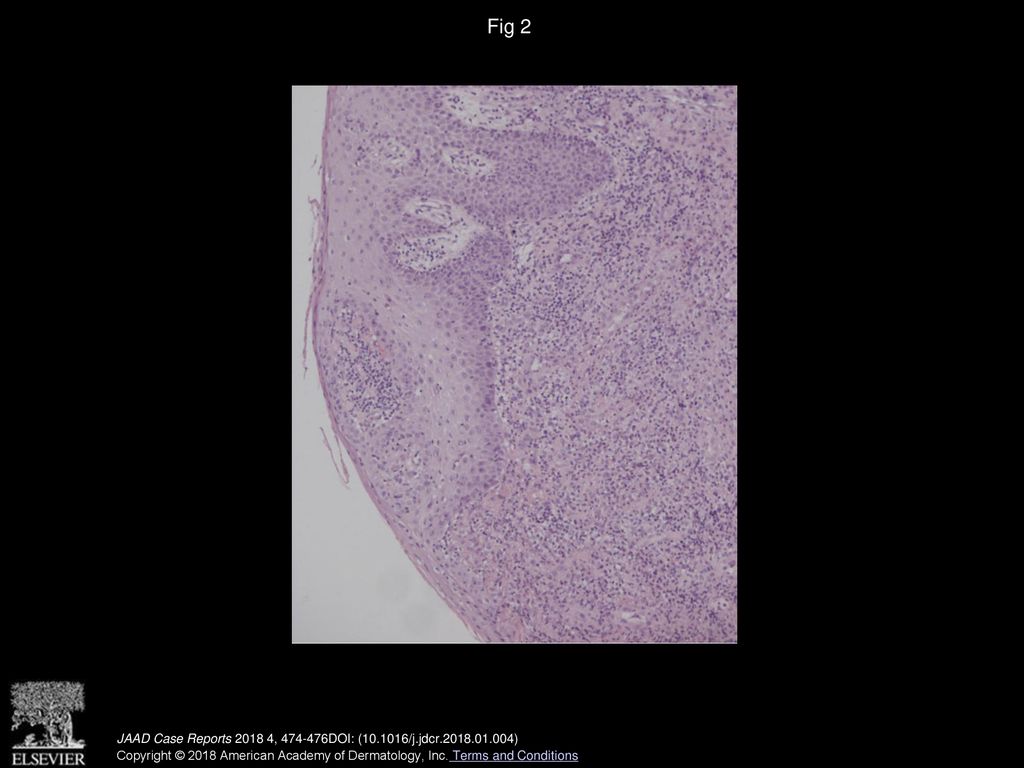 Fig 2 Nonspecific ulceration. (Hematoxylin-eosin stain; original magnification: ×10.)