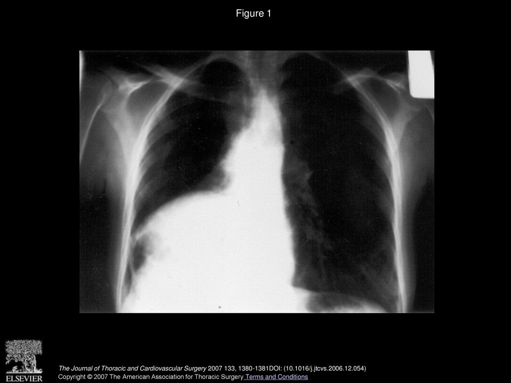 Figure 1 Chest radiograph indicating an elevation of the right hemidiaphragm with dextrocardia.