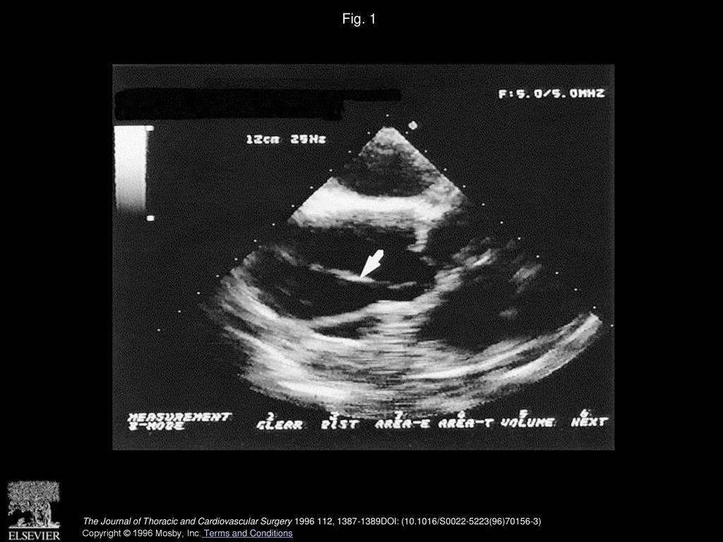 Fig. 1 Monoplanar TEE of the ascending aorta. Arrow indicates image of intimal flap above aortic valve.