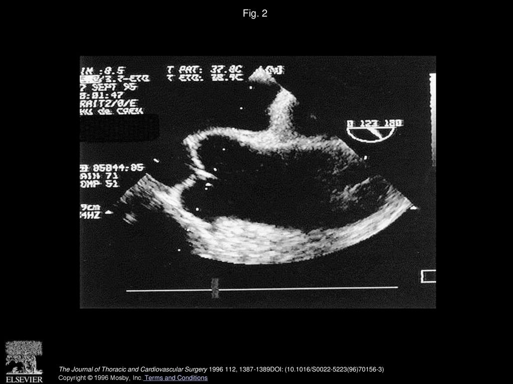 Fig. 2 With multiplanar TEE, no intimal flap image is shown in ascending aorta above aortic valve.