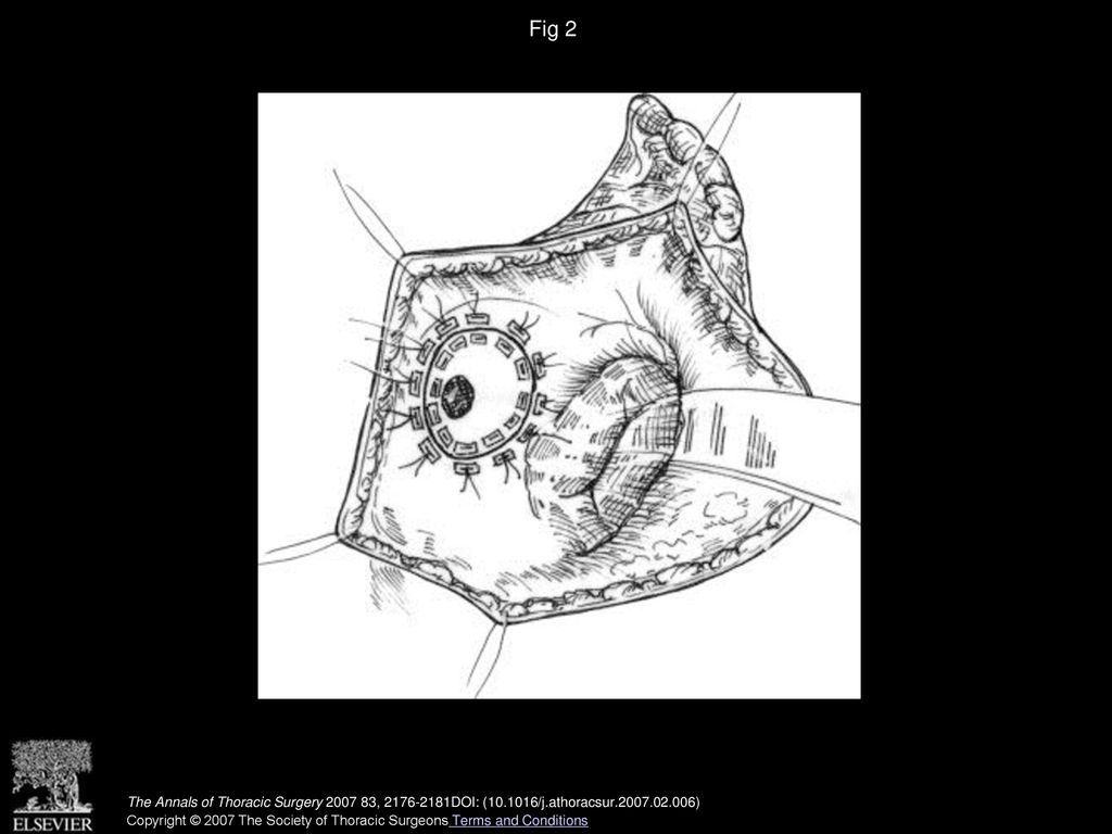 Fig 2 Illustration of the unidirectional monovalve homologous aortic patch in place.