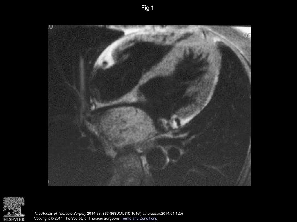 Fig 1 Magnetic resonance imaging of large paraganglioma.