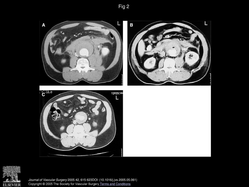 Fig 2 Progress of a periaortic hematoma: preoperative scan (A), 3 days after surgery (B), and 10 months later (C).