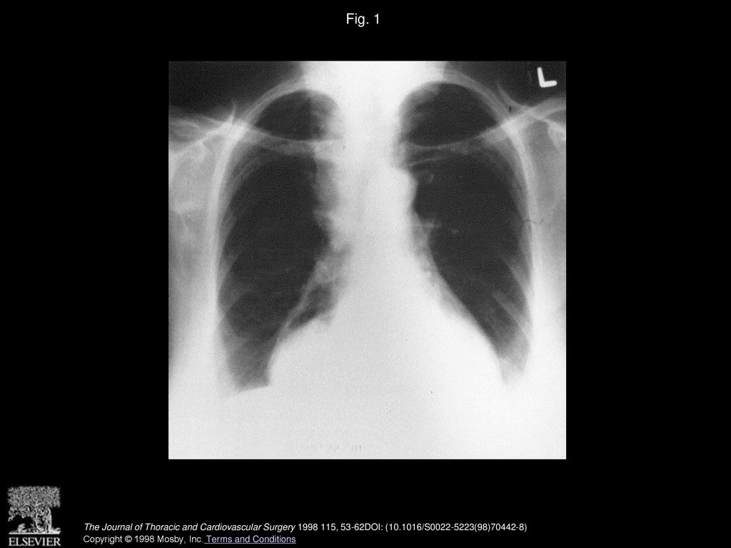 Fig. 1 Chest radiograph demonstrating an intrathoracic stomach.
