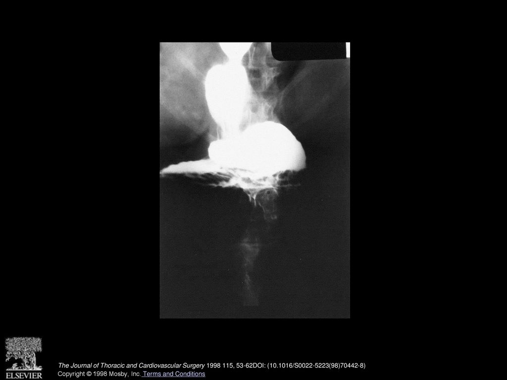 Fig.3.Contrast barium radiograph demonstrating an intrathoracic stomach with complete obstruction at the pylorus.