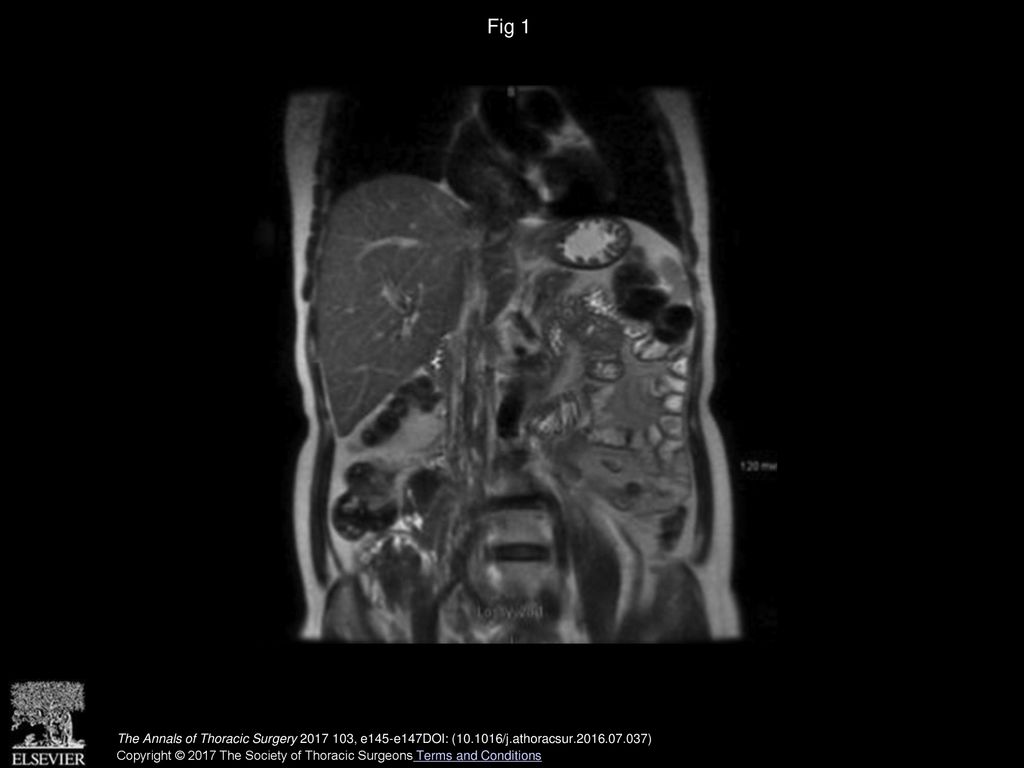 Fig 1 Coronal magnetic resonance imaging demonstrates a mass within the inferior vena cava extending into the right ventricle.