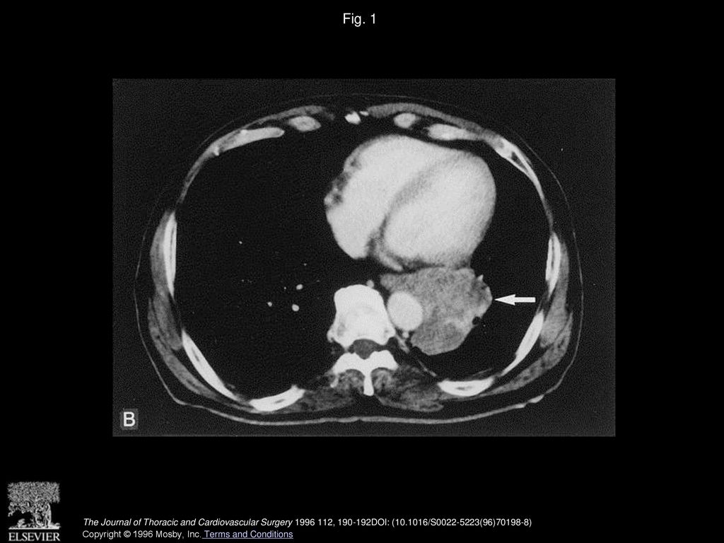 Fig. 1 Standard chest CT scan (A) of tumor 7 (arrow) showing that the tumor was in contact with the aortic wall. B, CT scan of tumor 1.