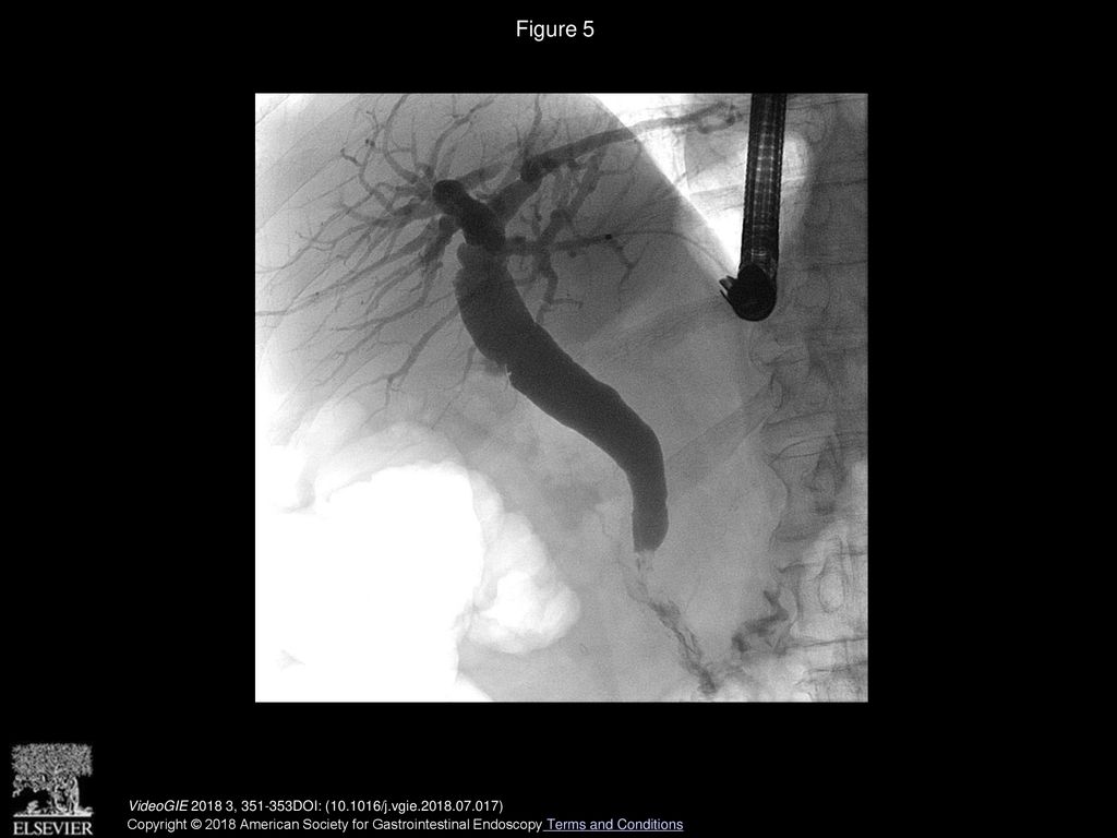 Figure 5 Cholangiographic view 6 weeks after transjejunal cholangioscopy with electrohydraulic lithotripsy, confirming stone-free biliary system.