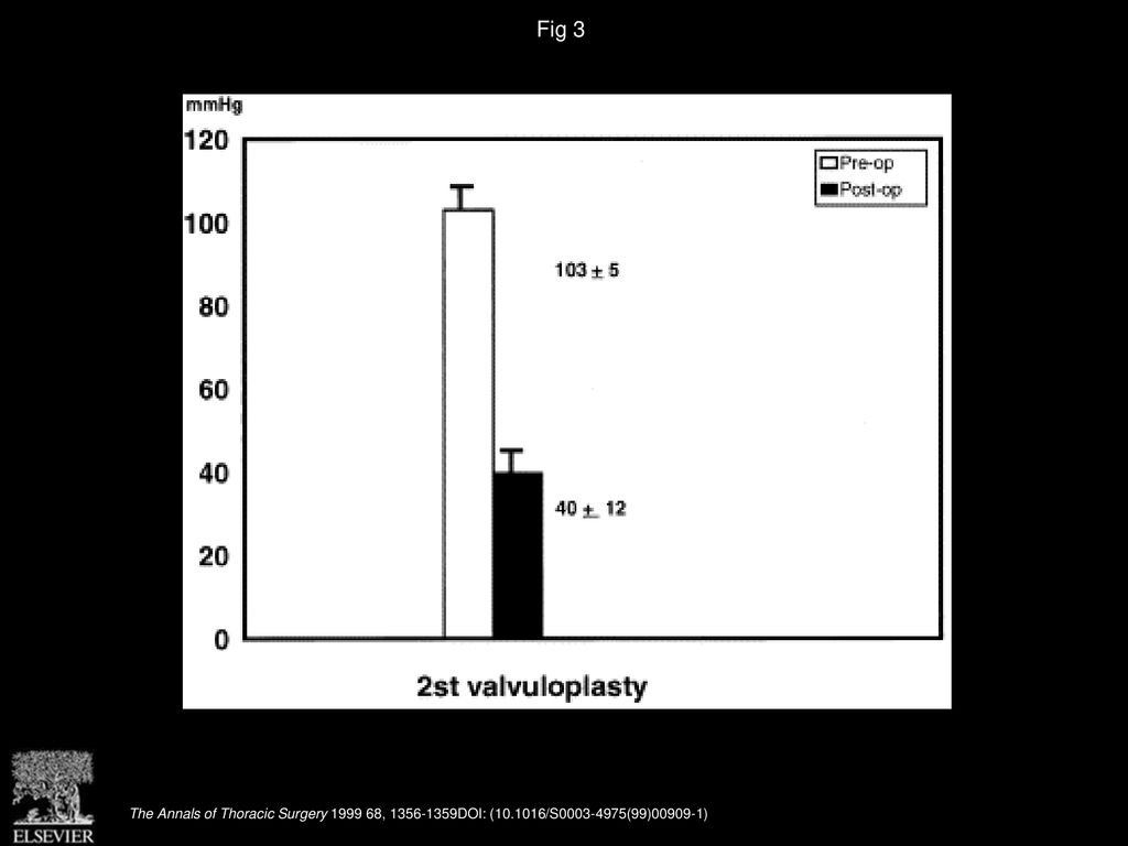 Fig 3 Gradients before and after the second valvuloplasty. The results are expressed as mean ± standard deviation.