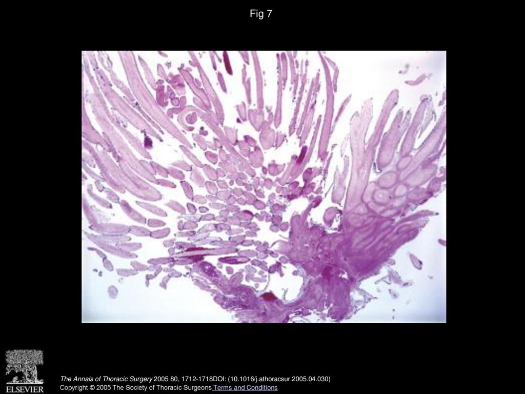 Fig 7 Microscopic appearance of a cardiac fibroelastoma of the mitral valve, showing multiple fronds (hematoxylin and eosin, low power).